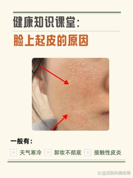 高原皮肤干燥怎么办_高原脸干起皮怎么快速缓解