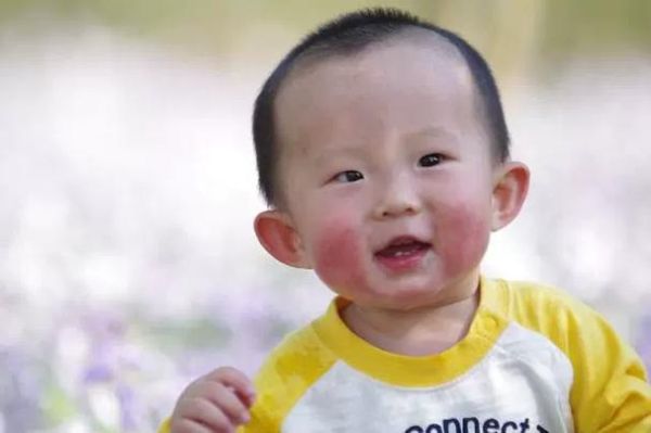 日本高原红小女孩_高原红成因