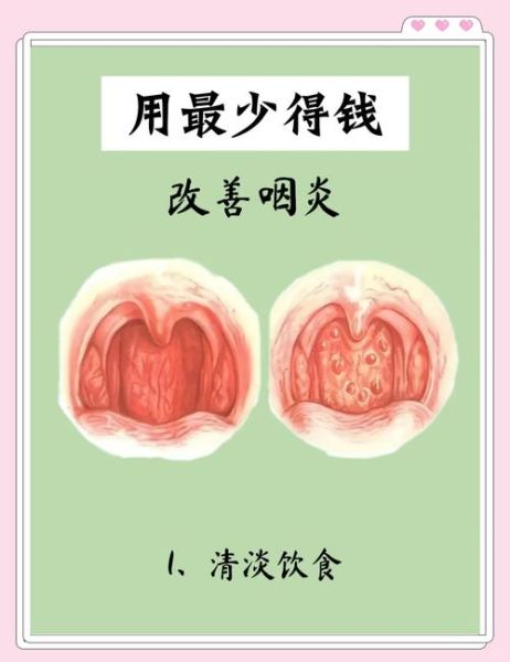 咽炎去高原会严重吗_如何缓解症状