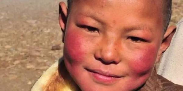 高原红图片_高原红怎么消除