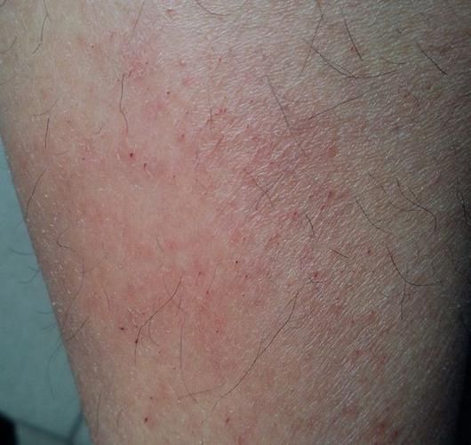 高原反应会不会过敏_高原过敏症状有哪些