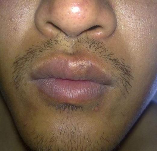 高原反应头疼嘴唇发紫_怎么办