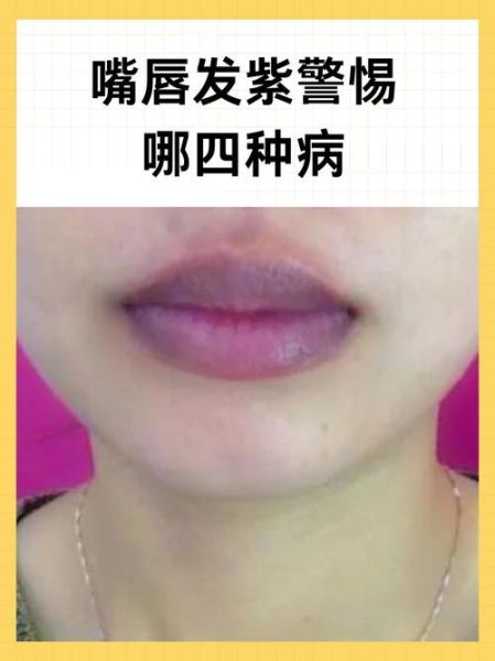 高原反应头疼嘴唇发紫_怎么办