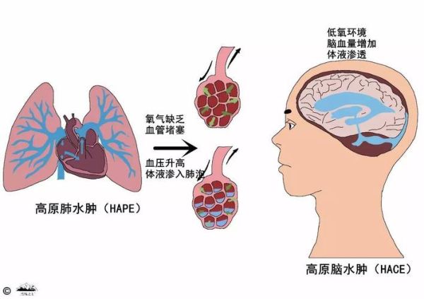 怎么测试高原反应_高原反应自测方法