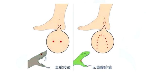 户外防蛇穿什么鞋_被蛇咬了怎么办