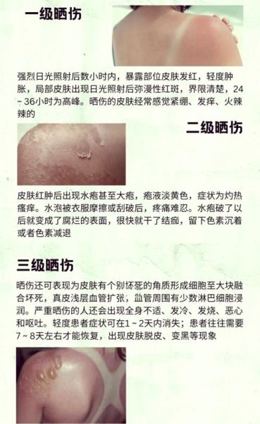 高原晒伤怎么处理_高原晒伤多久能好