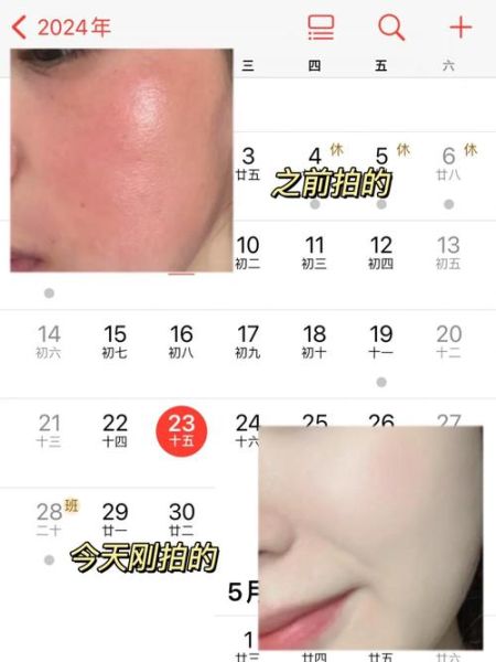 高原晒伤怎么处理_高原晒伤多久能好