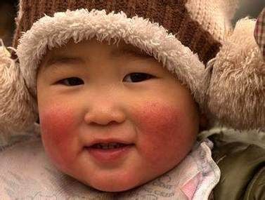 高原红长沙怎么治_高原红长沙会自愈吗