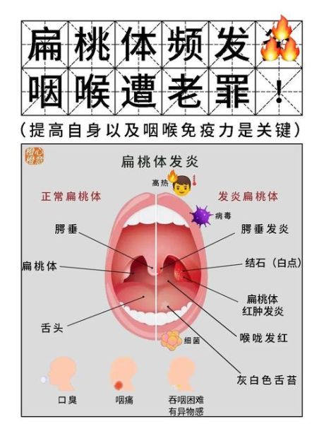 扁桃体发炎能上高原吗_高原反应会加重吗